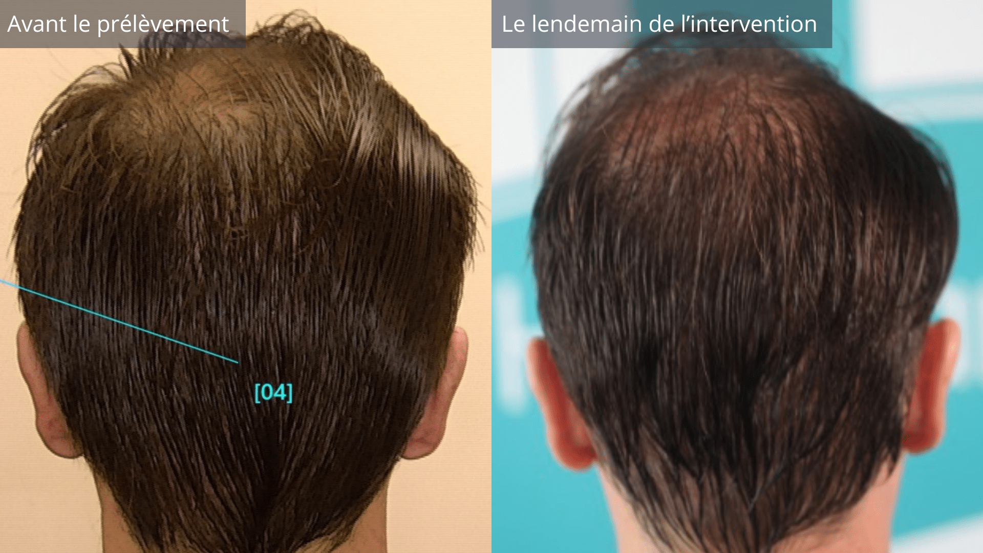 Avant/Après prélèvement greffe de cheveux sans rasage