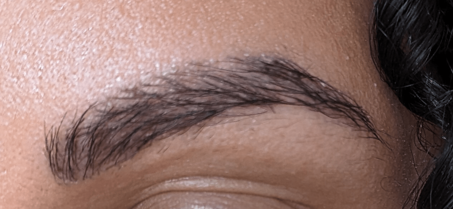 Greffe de sourcils avec la technique Long Hair FUE