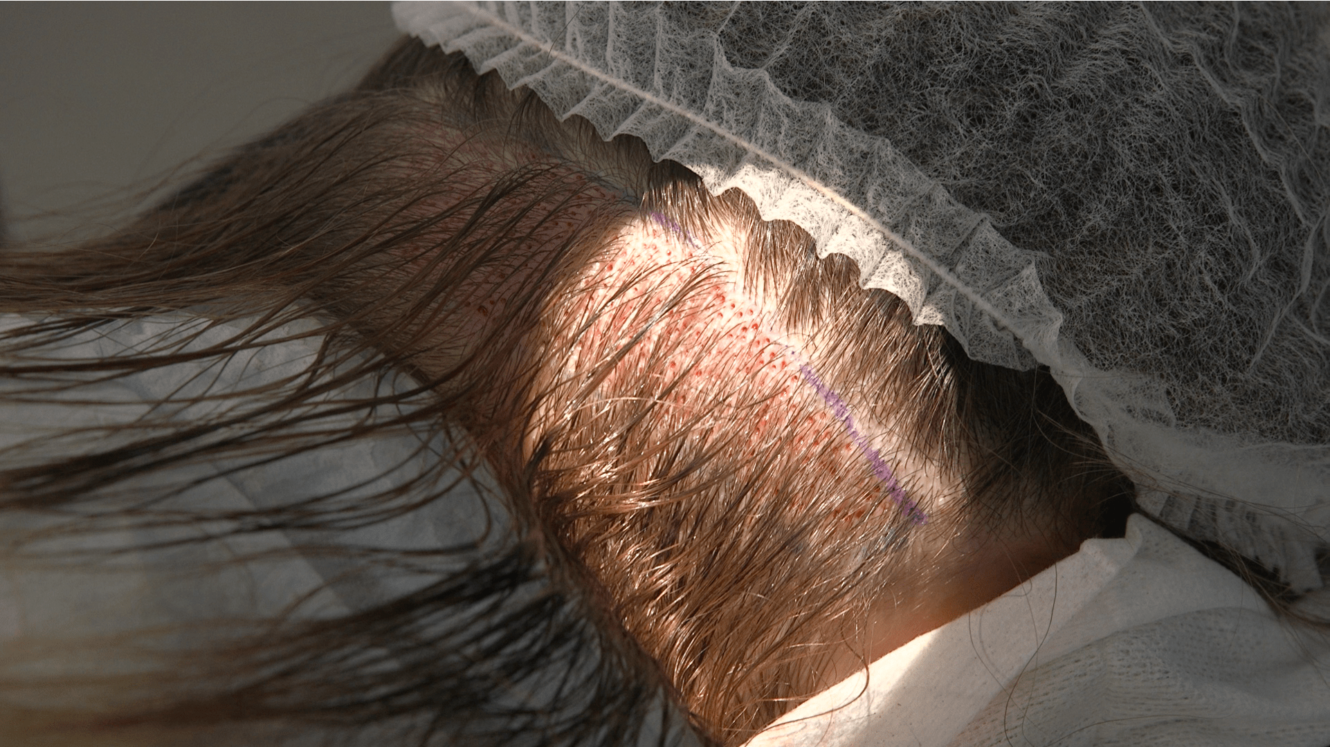 Prélèvement pour une greffe de cheveux sans rasage