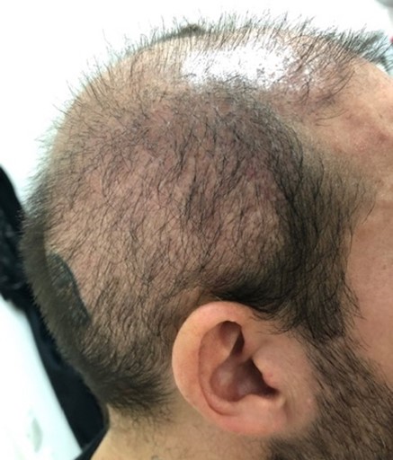 Prélèvement excessif sur la zone donneuse après une greffe à l'étranger