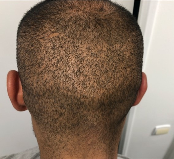 Greffe de cheveux à l'étranger avec prélèvement excessif