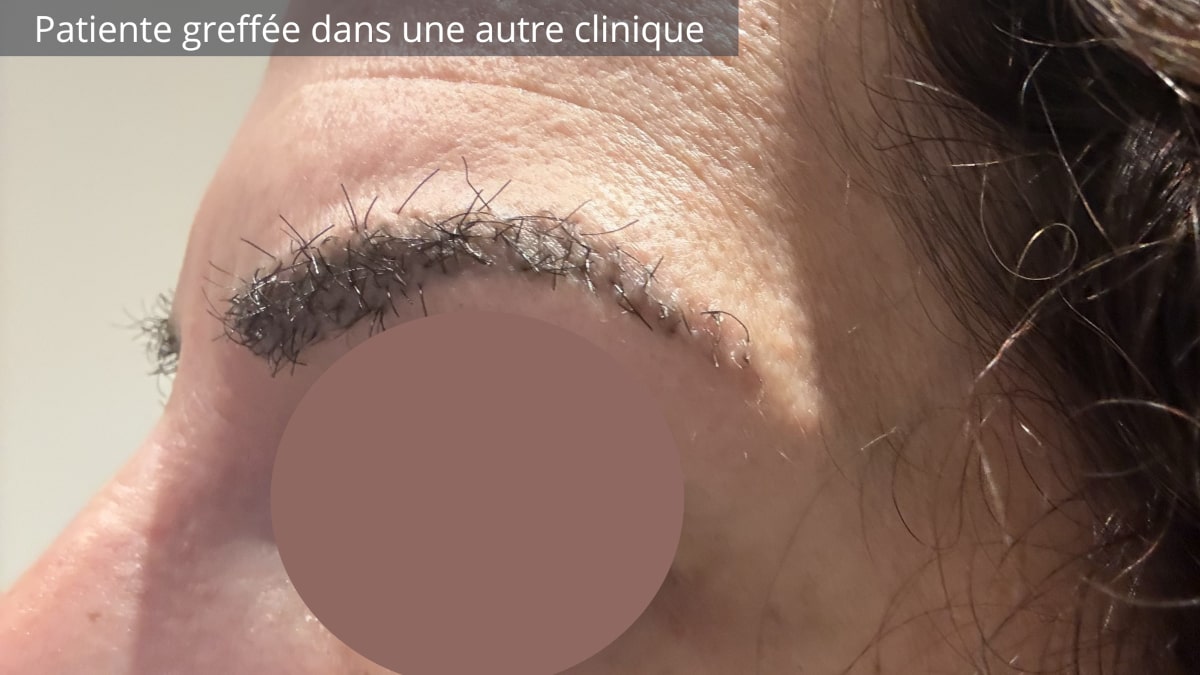 Orientation anarchique des poils implant&eacute;s