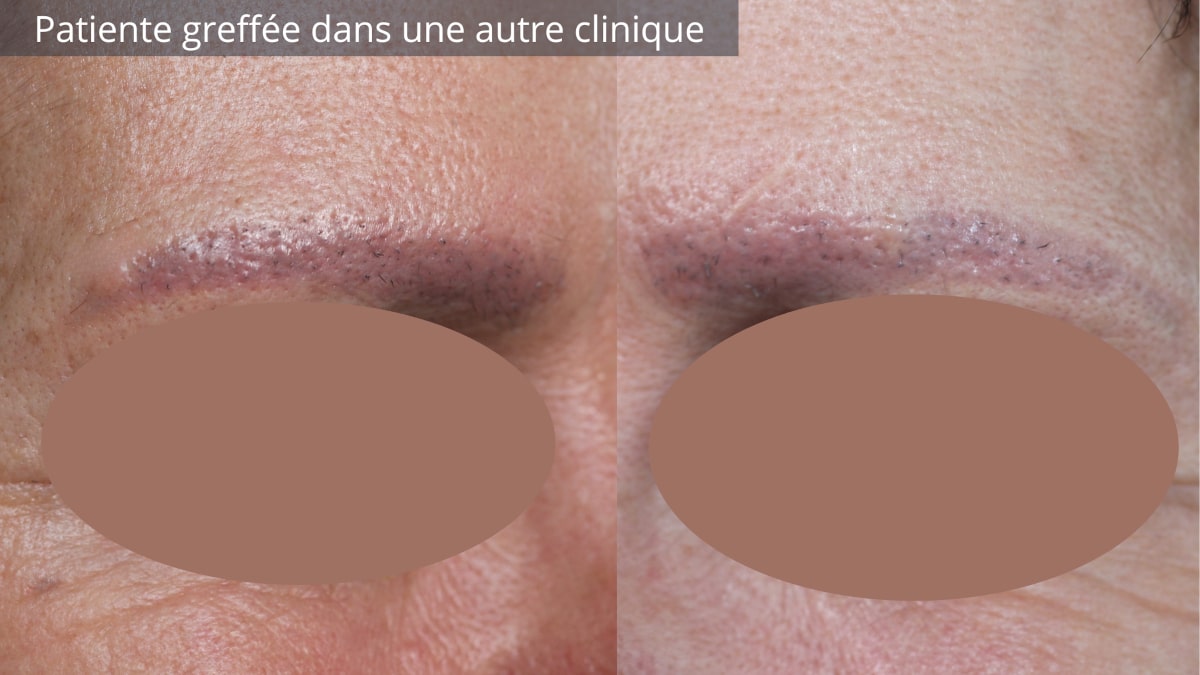 Rougeurs persistantes