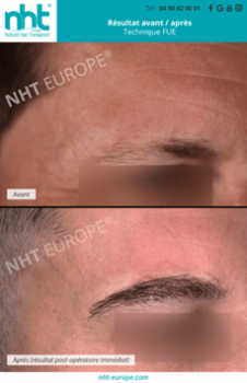 R&eacute;sultat greffe de sourcils NHT 3