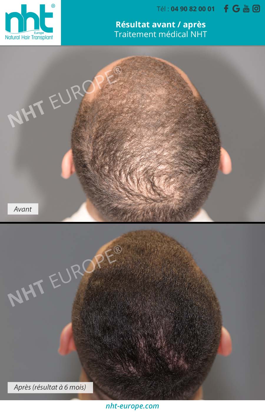 Alopécie : Causes et nouveaux traitements perte de cheveux