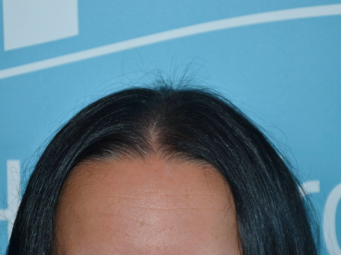 Long Hair FUE après intervention