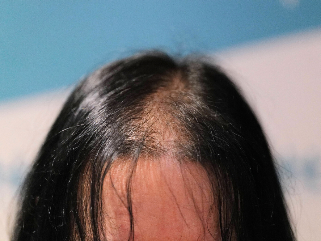 Long Hair FUE avant intervention