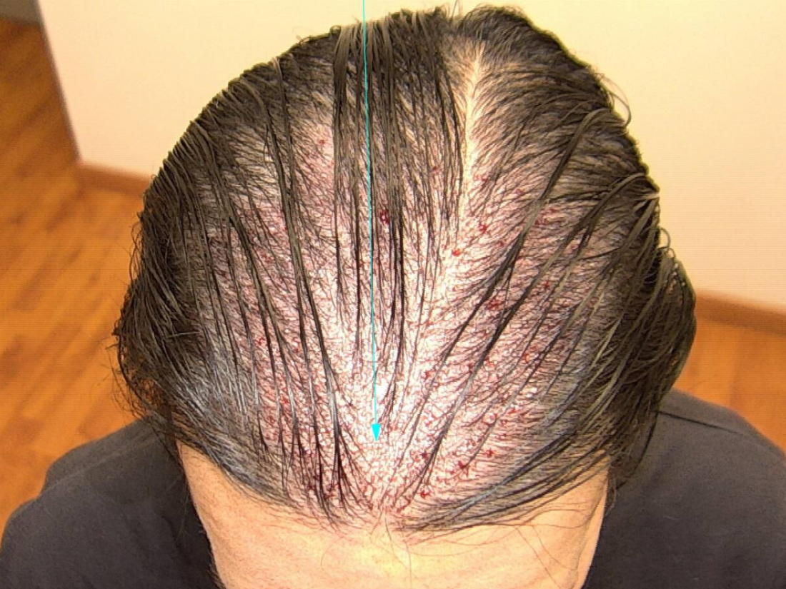 Technique Long Hair FUE sans aucun rasage à Avignon