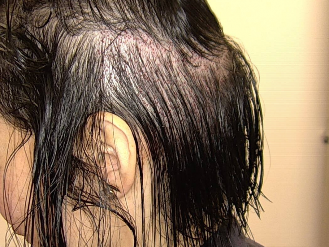 Technique Long Hair FUE sans aucun rasage