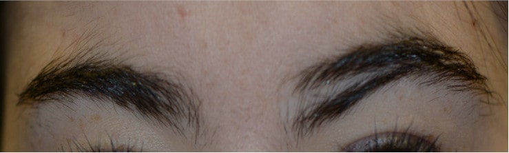 Pourquoi une greffe de sourcils ?