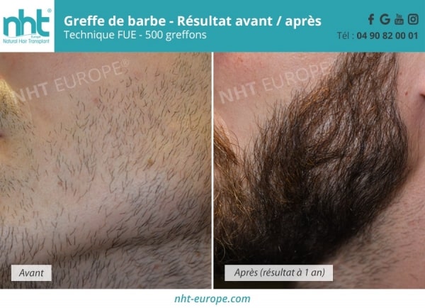 Résultats avant / après greffe de barbe