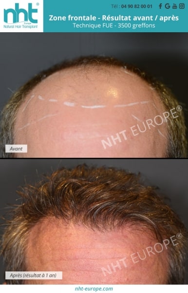 Résultats greffe de cheveux