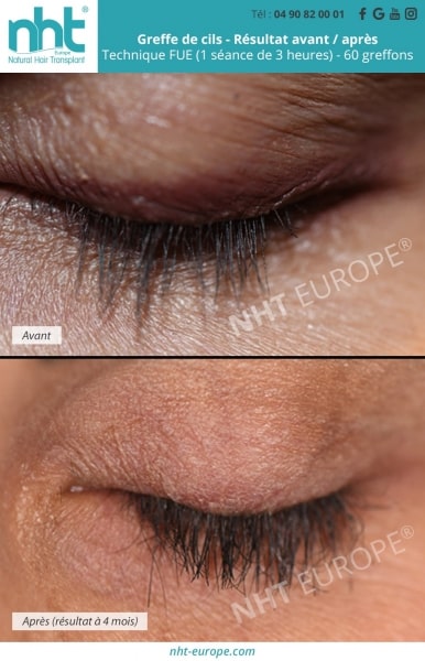 Résultats avant / après greffe de cils et sourcils
