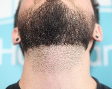 Greffe de barbe dessous
