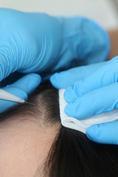 Implantation Long Hair FUE