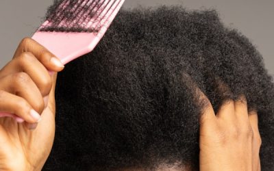 Greffe de cheveux sur cheveux crépus/afro