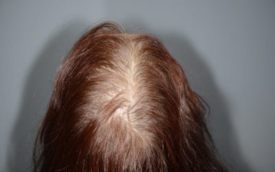 La calvitie chez la femme