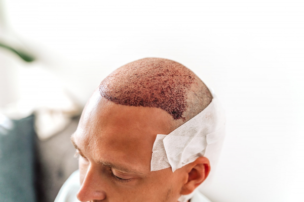 Les cheveux greffés vont-ils tomber au fil du temps ?