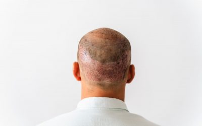 La greffe de cheveux laisse-t-elle des cicatrices sur le crâne ?