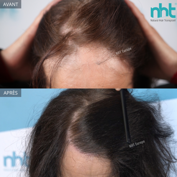 greffe-capillaire-solution-alopecie-avignon