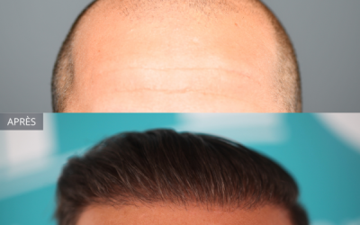 Greffe de cheveux : Une transformation radicale avec 6600 Greffons pour un patient de 35 ans à Avignon