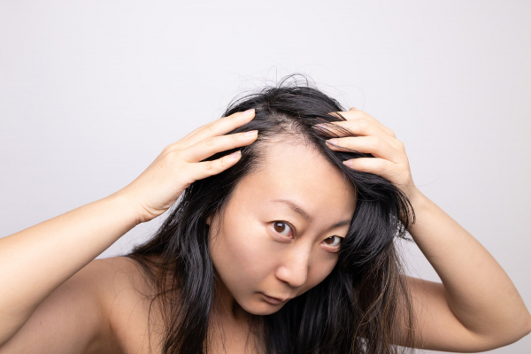La greffe de cheveux est-elle réservée aux hommes ?