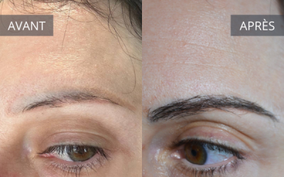 Greffe de sourcils après un tatouage des sourcils et microshading : le parcours d’une patiente à Avignon