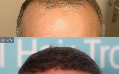 Résultat d’une greffe de cheveux de 4500 greffons après 1 an