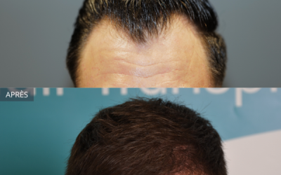 Résultat d’une greffe de cheveux modérée