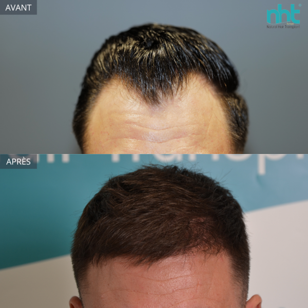 Résultat d’une greffe de cheveux modérée