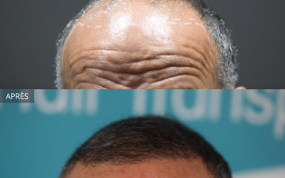 Résultat d’une méga greffe de cheveux de 6000 greffons