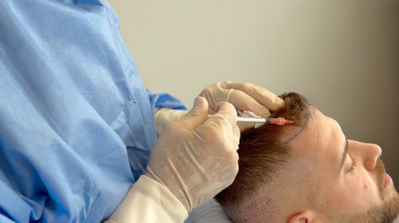 Injection de cellules souches Nanofat pendant une greffe FUE rasage partiel