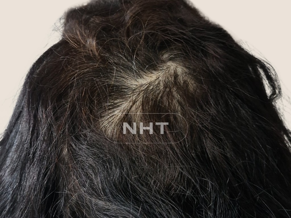 Résultat Greffe femme FUE Long Hair sur cicatrice après 7 ans - Zone Vertex - 1 jour - 1500 greffons